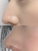 鷹鉤鼻子整形要多少錢(qián)(鷹鉤鼻子整形要多少錢(qián)費(fèi)用)