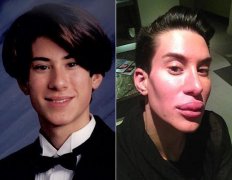 硅膠整形多少錢(隆鼻硅膠多少錢)