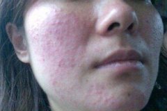 擦很多品牌防曬霜都過敏(擦很多品牌防曬霜都過敏怎么辦)