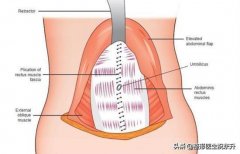 腹部整形手術(shù)疼嗎多少錢(qián)(腹部整形應(yīng)該去什么醫(yī)院)