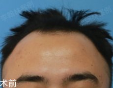 發(fā)際線整形價(jià)格一般多少(整容發(fā)際線多少錢(qián))