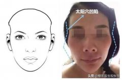 頭骨輪廓整形費(fèi)用多少呢(額骨整形需要多少錢)