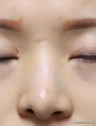 祛鼻翼整形多少錢啊(整鼻翼多少錢一般多少錢)