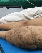 整形醫(yī)院切肉瘤價(jià)格多少(肉瘤割除需要多少錢(qián))