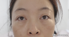 去眼袋整形手術(shù)費(fèi)多少(去眼袋整形手術(shù)費(fèi)多少)