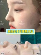 做整形鼻子大概多少錢(整形鼻子大概要多少錢)