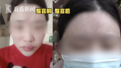 額頭有坑整形需要多少錢(qián)(額頭有坑整形需要多少錢(qián)修復(fù))