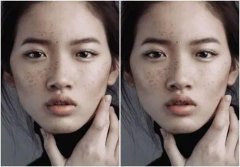 整形面部顴骨突出多少錢(顴骨太突出怎么改良需要多少錢)