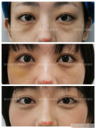 微整形割眼袋需要多少錢(整容割眼袋要多少錢)