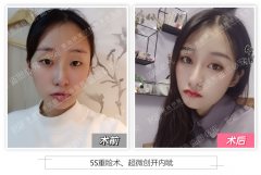 青島鼻子整形需要多少錢(青島鼻子整形需要多少錢費(fèi)用)