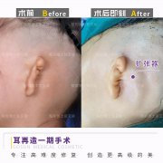 耳朵整形費用大概多少(耳朵整形手術(shù)的費用大概是多少錢)