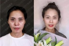 面部整形一個(gè)月費(fèi)用多少錢(面部整形大約費(fèi)用)